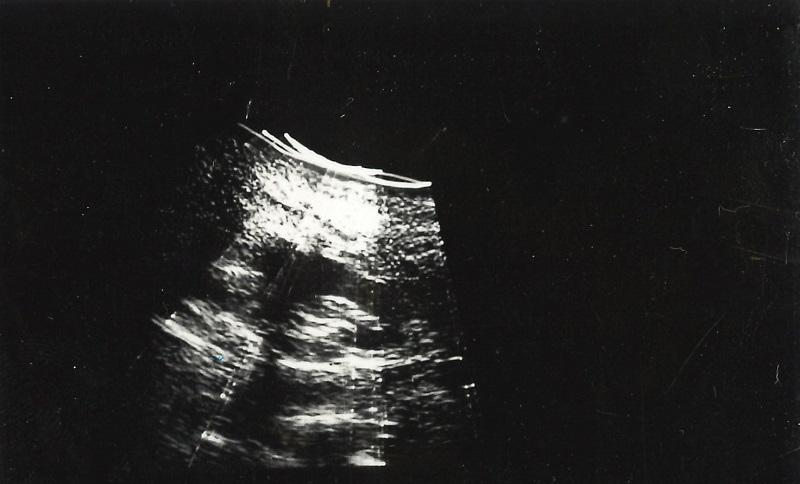 A black and white ultrasound image