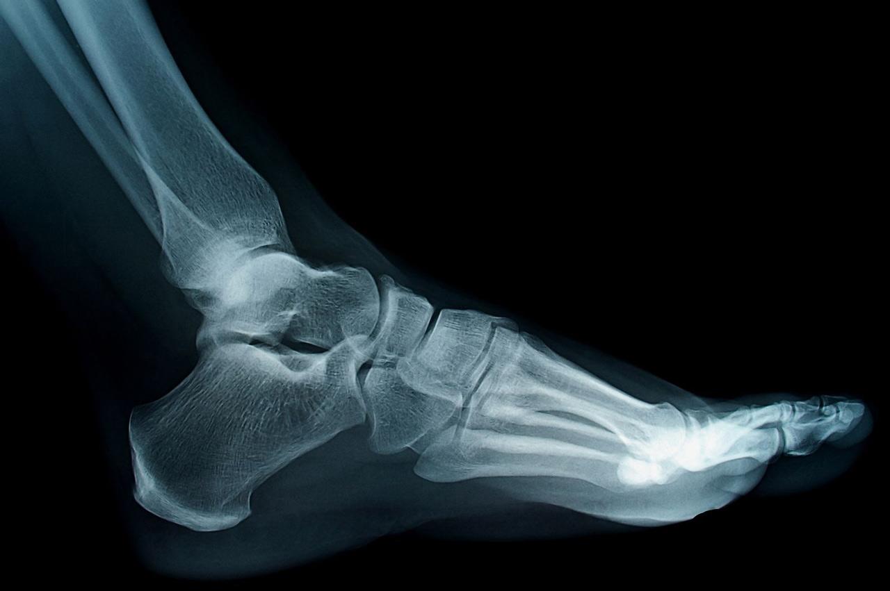 An xray of a foot